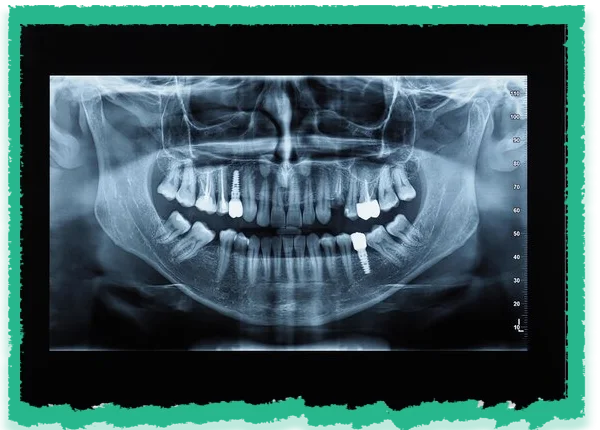 Dental X Ray