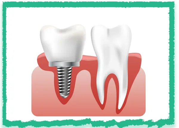 Dental Implant